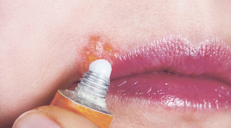 HERPES LABIAL
