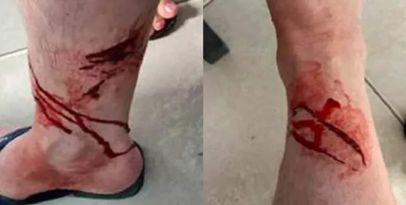 perna de crianca ferida por tubarao